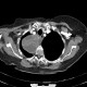 Neurofibroma of the thorax: CT - Computed tomography